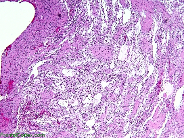 Pilocytic Astrocytoma x20