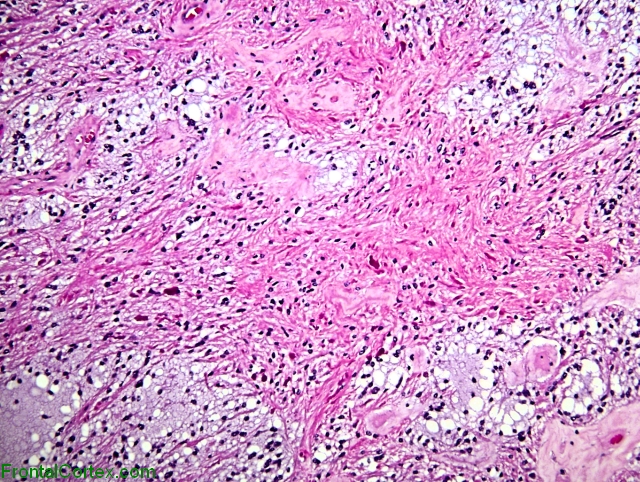 Pilocytic Astrocytoma x200