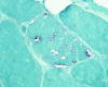 Inclusion body myositis, Gomori trichrome stain x 400