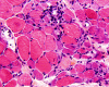 Paraneoplastic myositis, H&E stained section