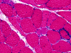 Polymyositis, H&E stained section