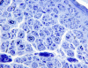 Hereditary sensory and motor neuropathy, type 1, sural nerve, toluidine blue X 600.