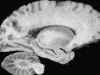 Sagittal gross section of normal brain