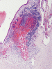 Germinal matrix hemorrhage, low power H&E stain