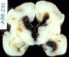 Intraventricular hemorrhage, coronal section