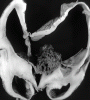 Massive hydrocephalus following intraventricular hemorrhage.