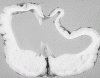 Severe post hemorrhagic hydrocephalus, coronal section through basal ganglia.