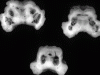 Multicystic Encephalopathy Brainstem