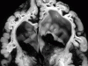 Multicystic Encephalopathy, horizontal  section