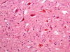 Acute hypotensive brainstem necrosis, hypoglossal nucleus, H&E stain