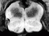 Hypotensive Brainstem Necrosis