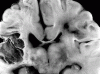 Intrauterine Infarct Coronal