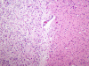 Hypotensive brainstem necrosis, organizing phase, H&E stain