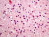 Organizing periventricular leukomalacia, high power H&E stain