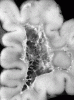 Periventricular leukomalaciawith advanced cavitation, right frontal lobe, coronal section.