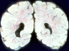 Periventricular leukomalacia, coronal