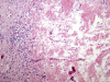 Periventricular leukomalacia, low-power H&E stained section