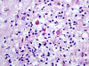 Organizing periventricular leukomalacia