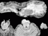 Porencephalywith with secondary cortical spinal tract degeneration, sagittal section of cerebrum with transverse sections of brainstem