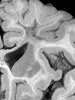 Late-delayed radiation necrosis, coronal section of brain