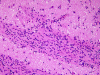 Anaplastic astrocytoma infiltrating corpus striatum, H&E stain x 200