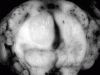 Brainstem Glioma in Spinal Cord Transverse