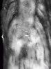 Leptomeningeal gliomatosis in a patient with brainstem glioma, gross photograph of cauda equina