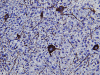 Infiltrating Glioma, Thalmus, neurofilament immunohistochemical staining x 200