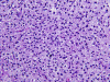 Inflitrating Glioma, Thalamus H&E stain x200