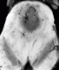 Tectal Glioma, Transverse section through midbrain