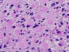 Gemistocytic astrocytoma, H&E stain x 100