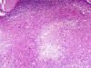 Glioblastoma Multiforme involving cerebellar white matter, H&E Stain X 40