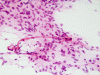 Glioblastoma multiforme, intraoperative smear preparation of drop metastasis, H&E x 100