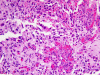 Glioblastoma multiforme presenting as extramedullary spinal tumor