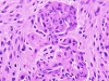 Glioblastoma multiforme, microvascular proliferation, H&E stain x 400.