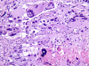 Monstrocellular Glioblastoma