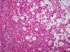 Lipoastrocytoma, H&E stain x100