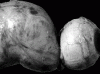 Pilocytic astrocytoma of optic nerve ("Optic Glioma"), Gross Photograph of Resected Specimen.