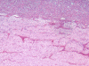 Pilocytic astrocytoma of optic nerve, with extension into optic nerve sheath, H&E stain x 40