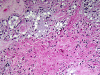 Pilocytic Astrocytoma, H&E stain x 400