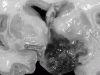 Pilomyxoid Astrocytoma,   Coronal sections through hypothalamus.