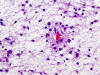 Pilomyxoid Astrocytoma, H&E stain x 200