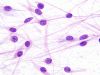 Pilomyxoid Astrocytoma,   Intraoperative smear preparation