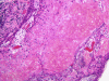 Craniopharyngioma, medium power H&E stained slide demonstrating "wet keratin".