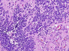 Anaplastic Ependymoma, high power H&E