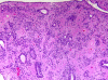 Ependymoma, low power H&E stained section