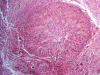 Intramedullary Ependymoma, transverse section through spinal cord, H&E stain x 40