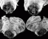 fourth ventricular ependymoma, transverse sections through brainstem and cerebellum.