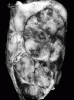 Myxopapillary Ependymoma, Sagittal Section