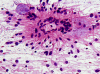 Myxopapillary Ependymoma, intraoperative smear preparation x 200